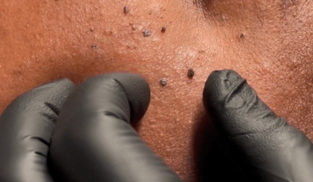 What Is DPN? The Small Dark Spots on Melanin-Rich Skin, and How We Remove Them Safely
